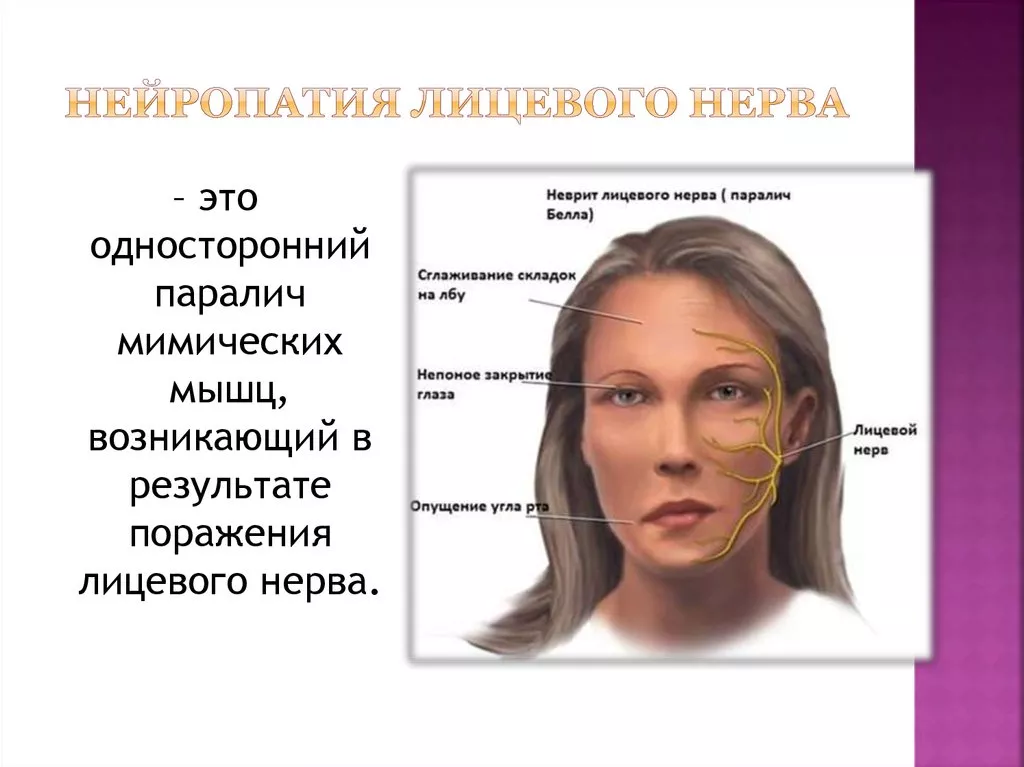 Лицевой нерв и его поражения: неврит, невралгия, невропатия, парез