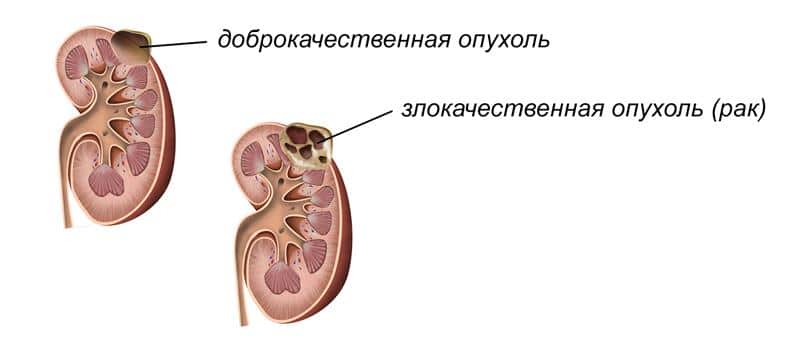 Доброкачественная опухоль новообразование — это рак или нет  Доброкачественные и злокачественные опухоли – признаки и отличия  В первую очередь, когда