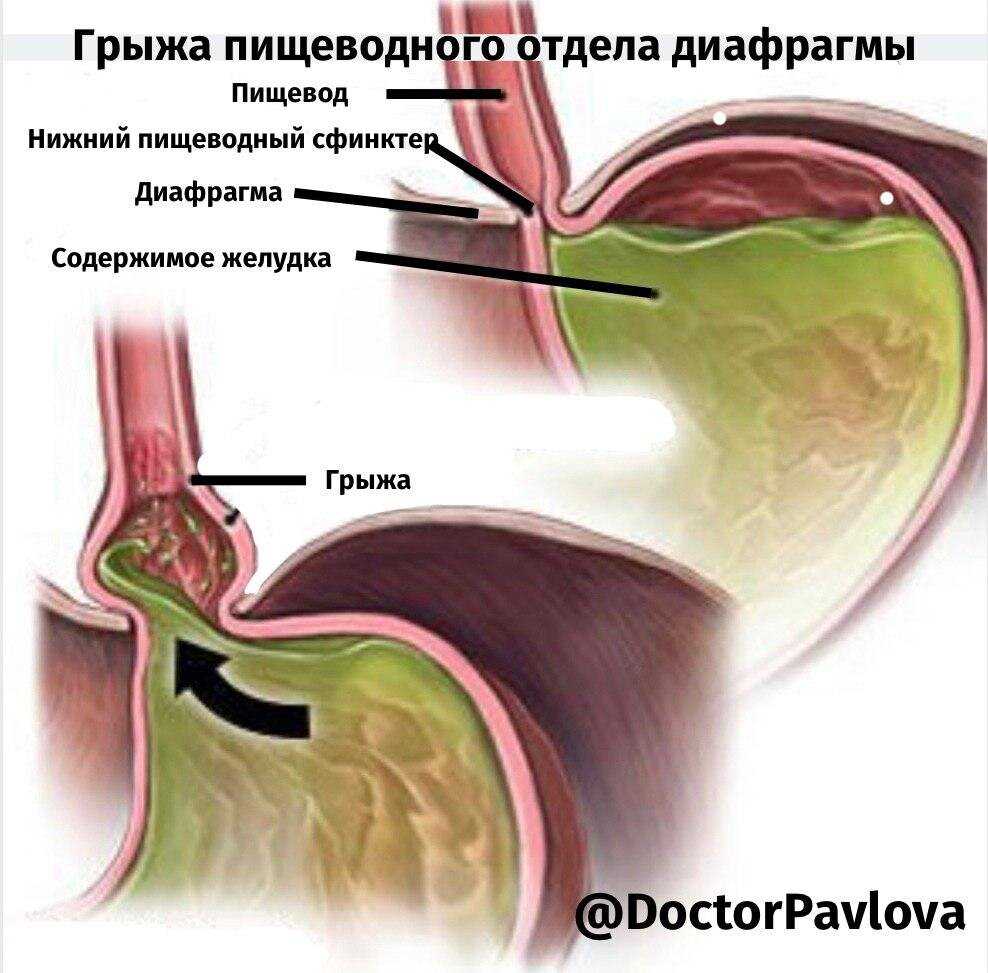 Грыжа пищеводного отверстия диафрагмы: симптомы и лечение