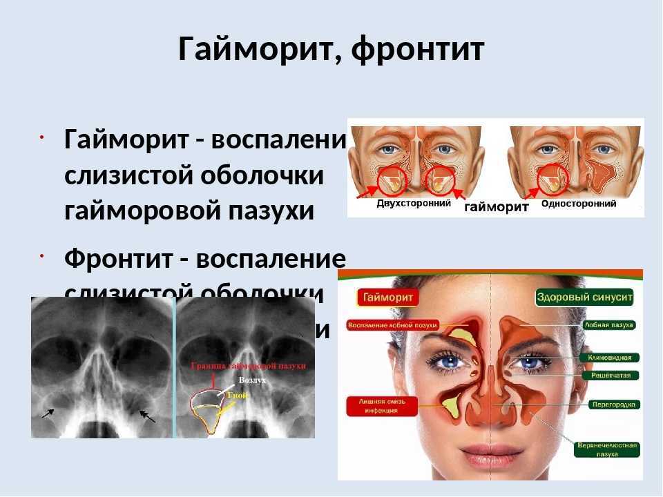 Первые признаки гайморита