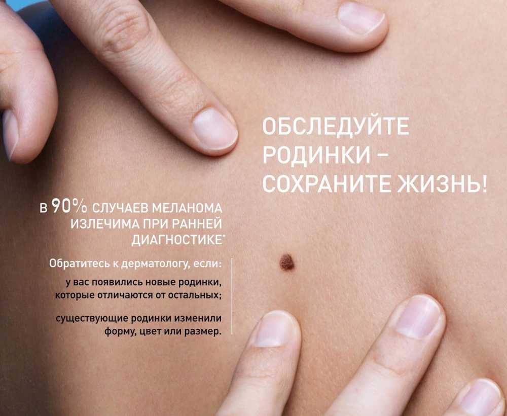 Удаление родинок на теле - с чего начать, к кому врачу нужно обратиться и каким методом лучше всего удалять.