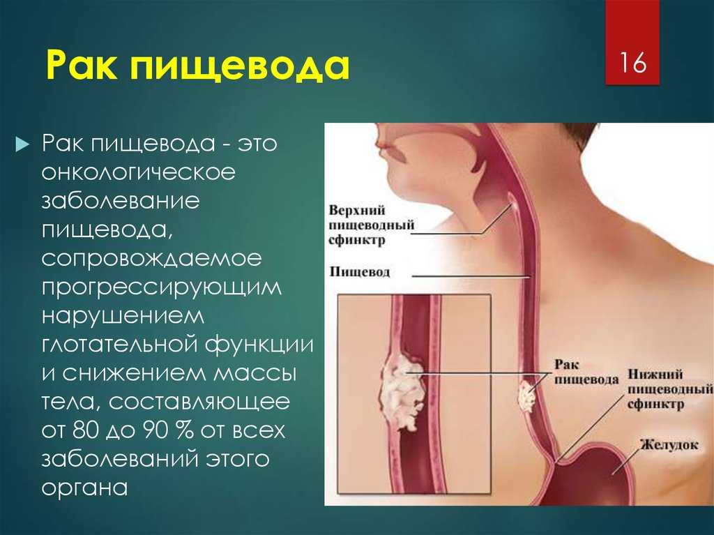 Рефлюкс-эзофагит: симптомы, причины и лечение, препараты