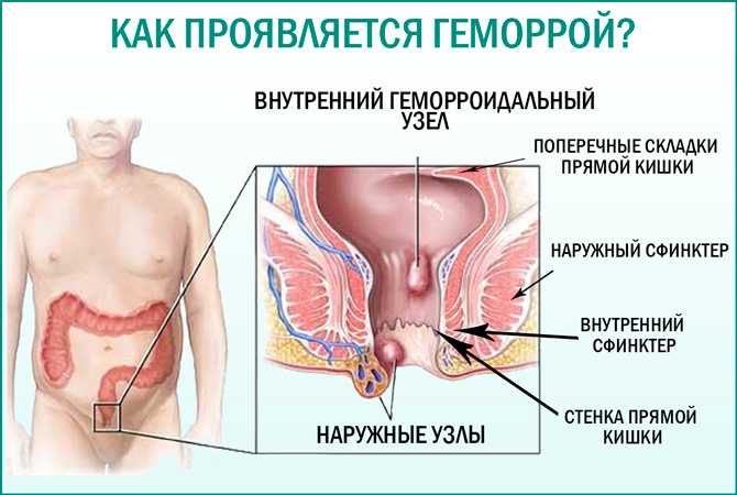 Массаж простатита: техника лечения массажем ануса при геморрое