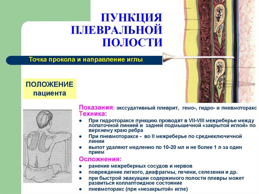 Плевральная пункция: алгоритм выполнения — med-anketa.ru