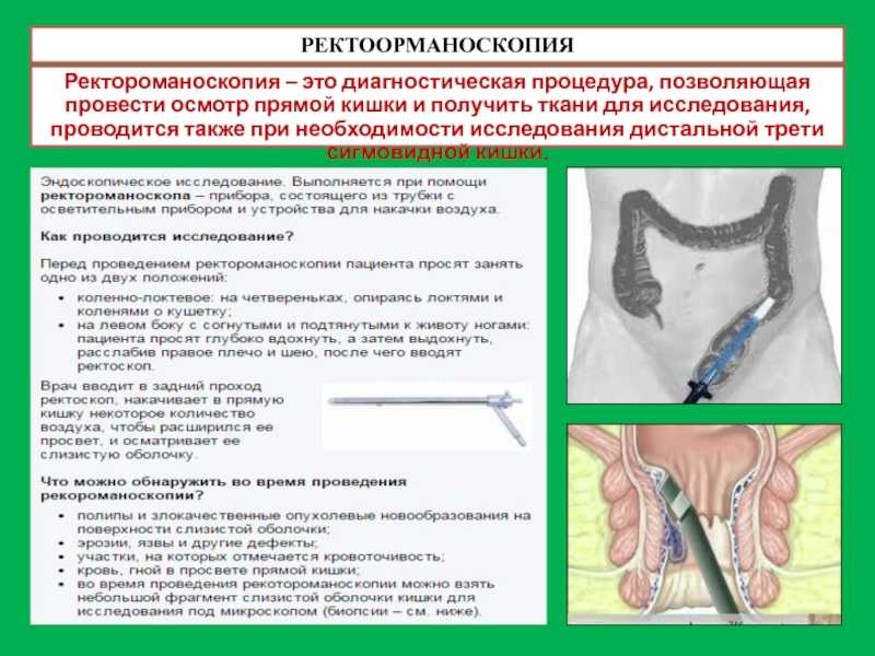 Основные отличия между ректороманоскопией и колоноскопией