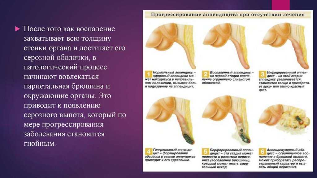 Гангренозный аппендицит: причины, послеоперационный период, последствия перфоративного аппендицита