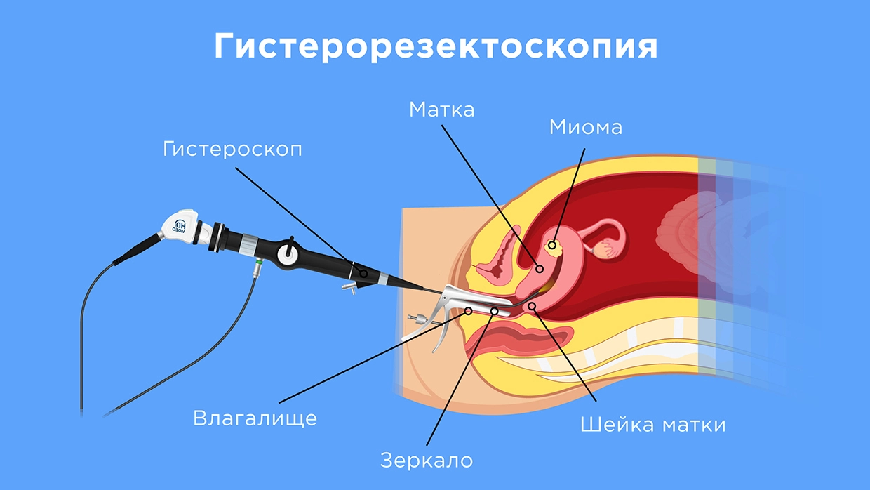 Удаление миомы матки: операция и показания, проведение, реабилитация  Послеоперационный период удаления миомы матки  Миома матки – это реакция женского