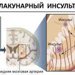 Лакунарный инсульт