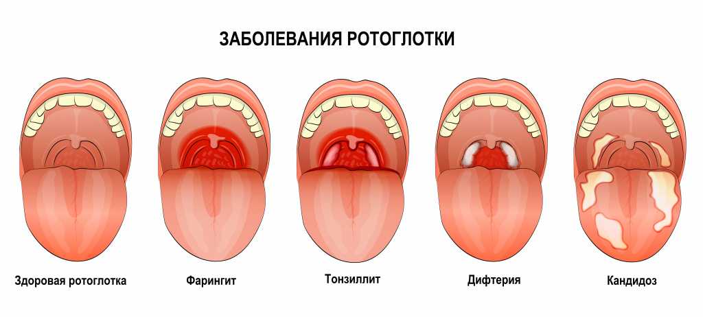 Нужно ли удалять кисту на миндалине? - наркологическая клиника в мытищах