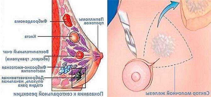 Удаление фиброаденомы молочной железы: методы, реабилитация | food and health