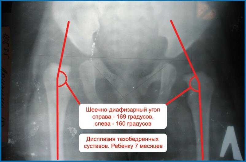 Узи врожденная дисплазия тазобедренных суставов (лекция на диагностере)