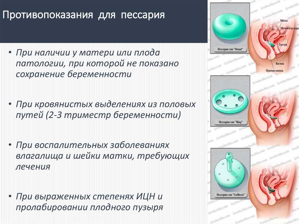 Стоит ли лечить опущение тазовых органов с помощью пессариев или лучше сделать операцию — центр эстетической медицины