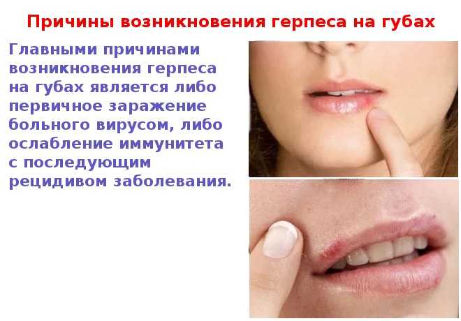 Герпес на губах: признаки, стадии, лечение