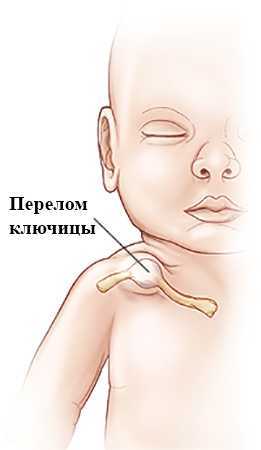 Перелом ключицы у новорожденного во время родов статьи