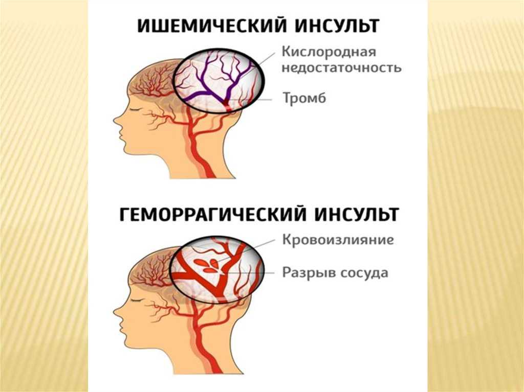Инсульт