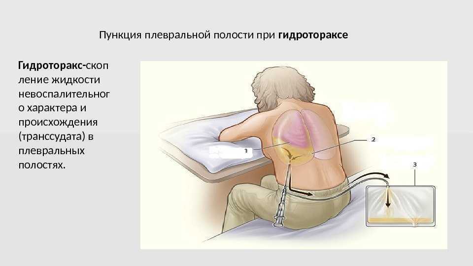 Плевральная пункция: набор инструментов, техника выполнения и алгоритм, подготовка, осложнения
