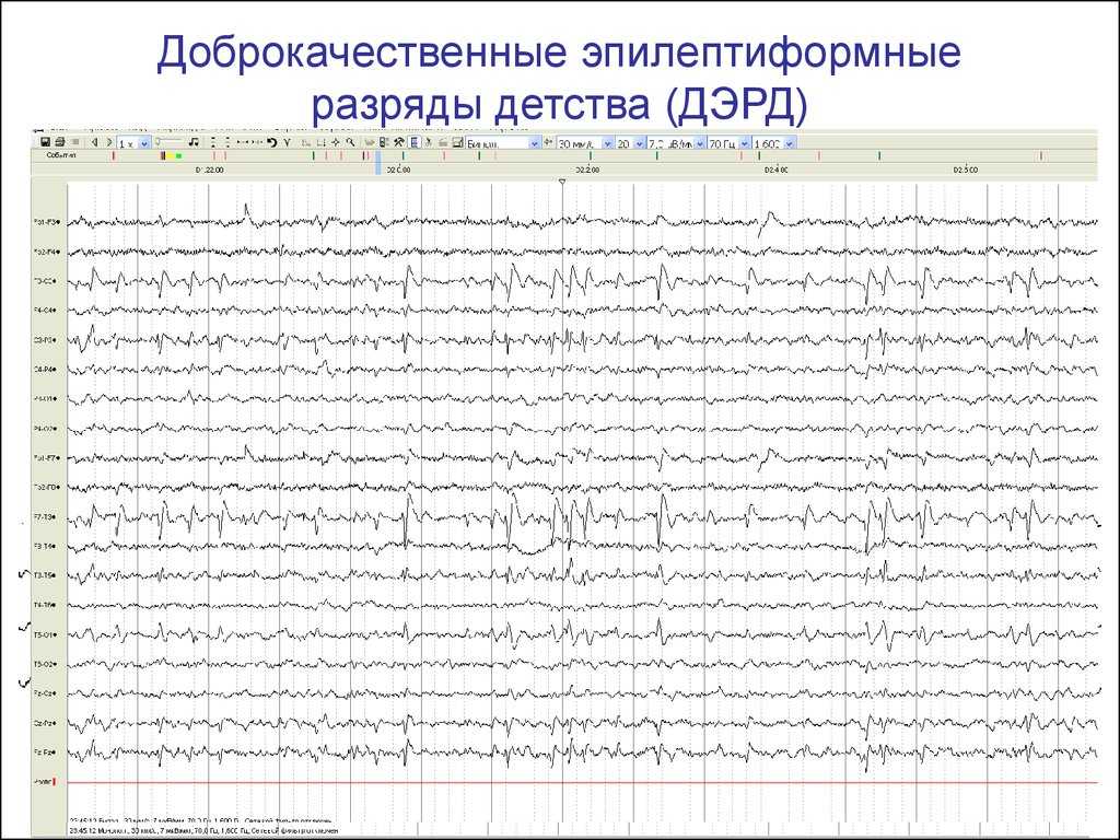 Эпилептиформная активность на  Э Э Г у ребёнка  Как и почему проявляется эпилептиформная активность на  Э Э Г  В современной диагностике различных неврологических