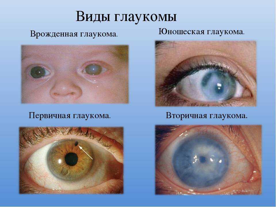 Вас не страшит неожиданная перспектива – полная слепота от глаукомы через 5-7 лет?