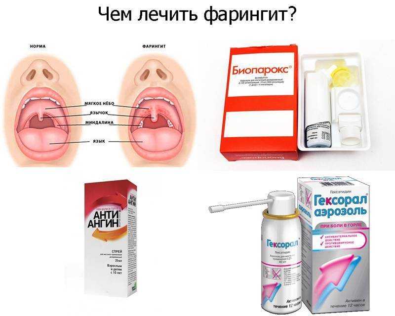 Ангина при грудном вскармливании, лечение заболевания у кормящей мамы