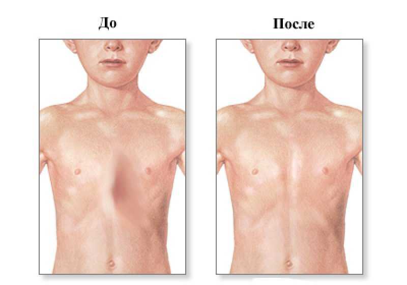 Деформация грудной клетки: причины, симптомы, лечение