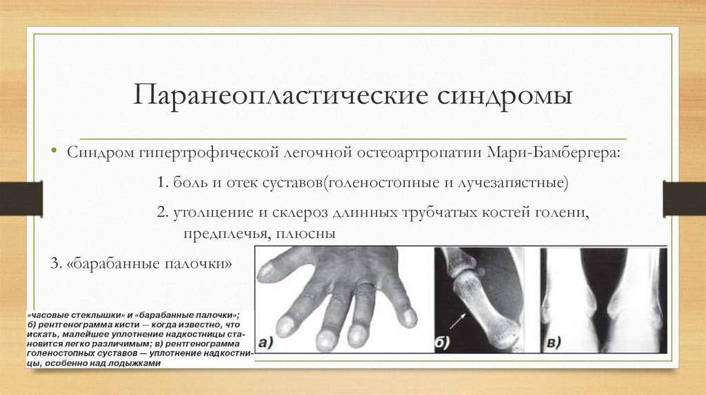 Паранеопластический синдром