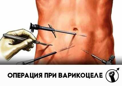 Операция при варикоцеле: как проходит хирургическое (оперативное) лечение варикоцеле