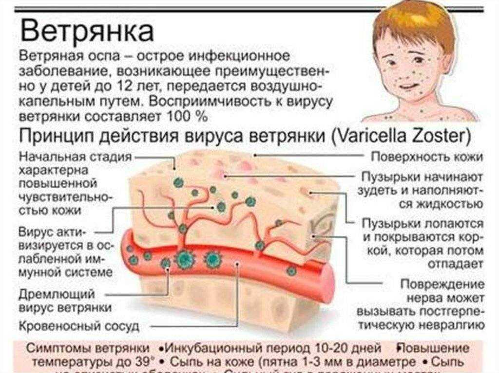Бывает ли ветрянка у грудничка?