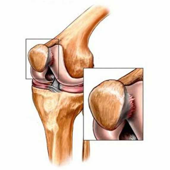 Что такое хондромаляция бедренной кости