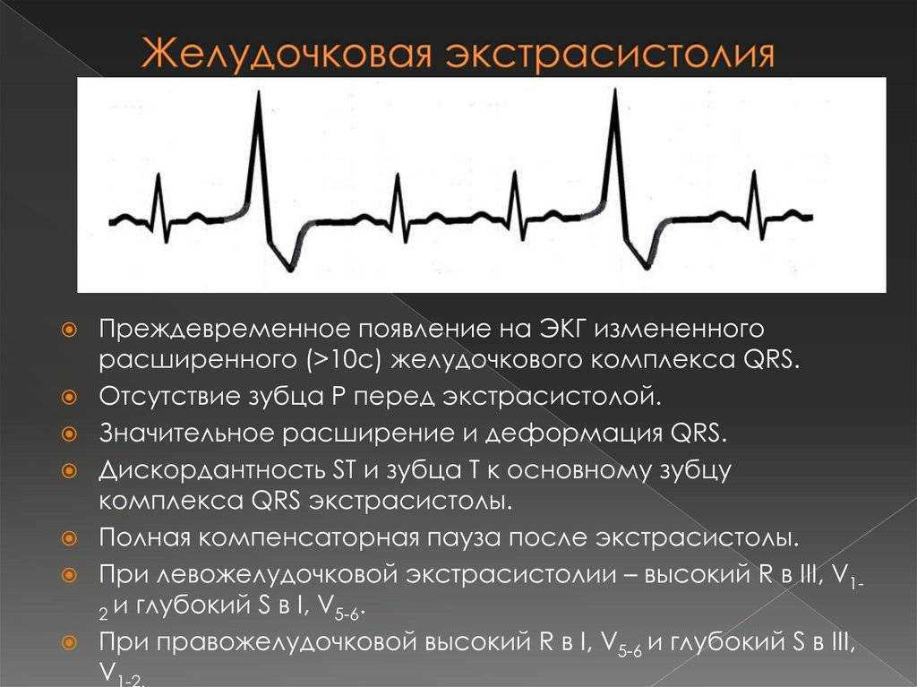 Желудочковая экстрасистолия: причины, симптомы, лечение