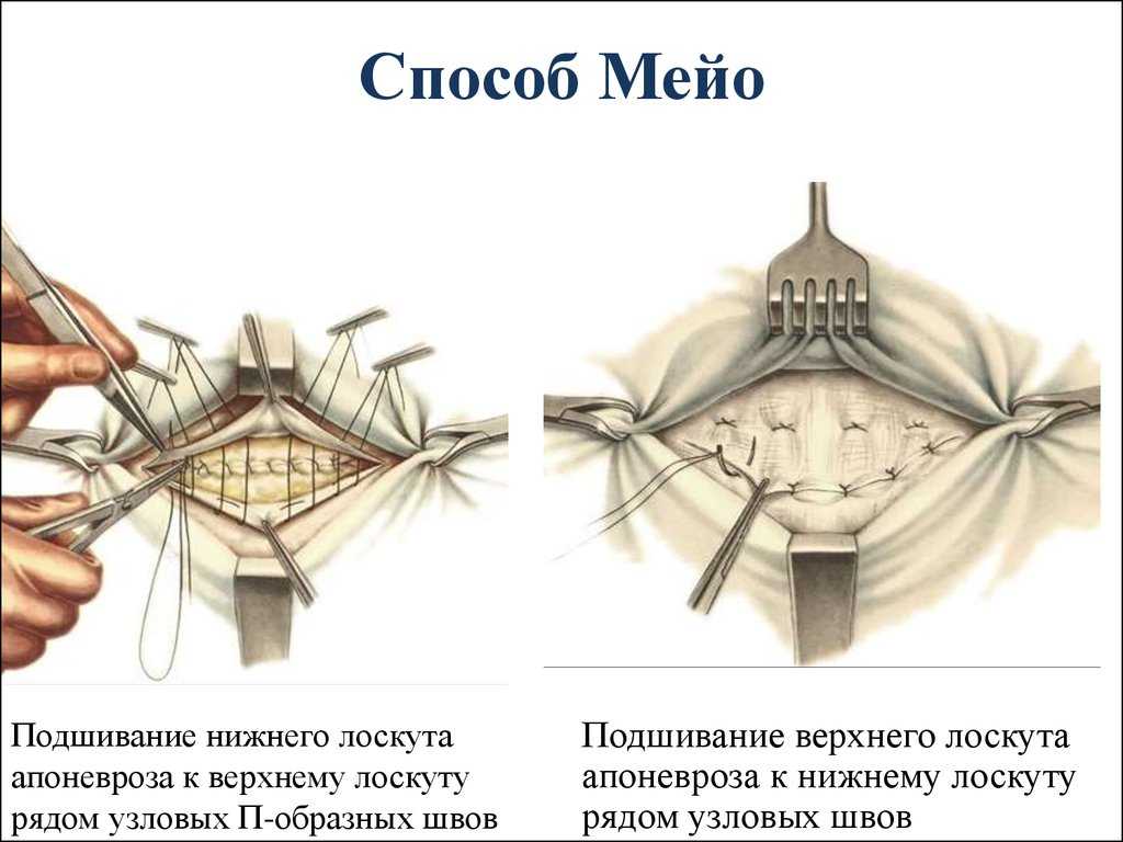Реабилитация после пупочной грыжи - физиоцентр