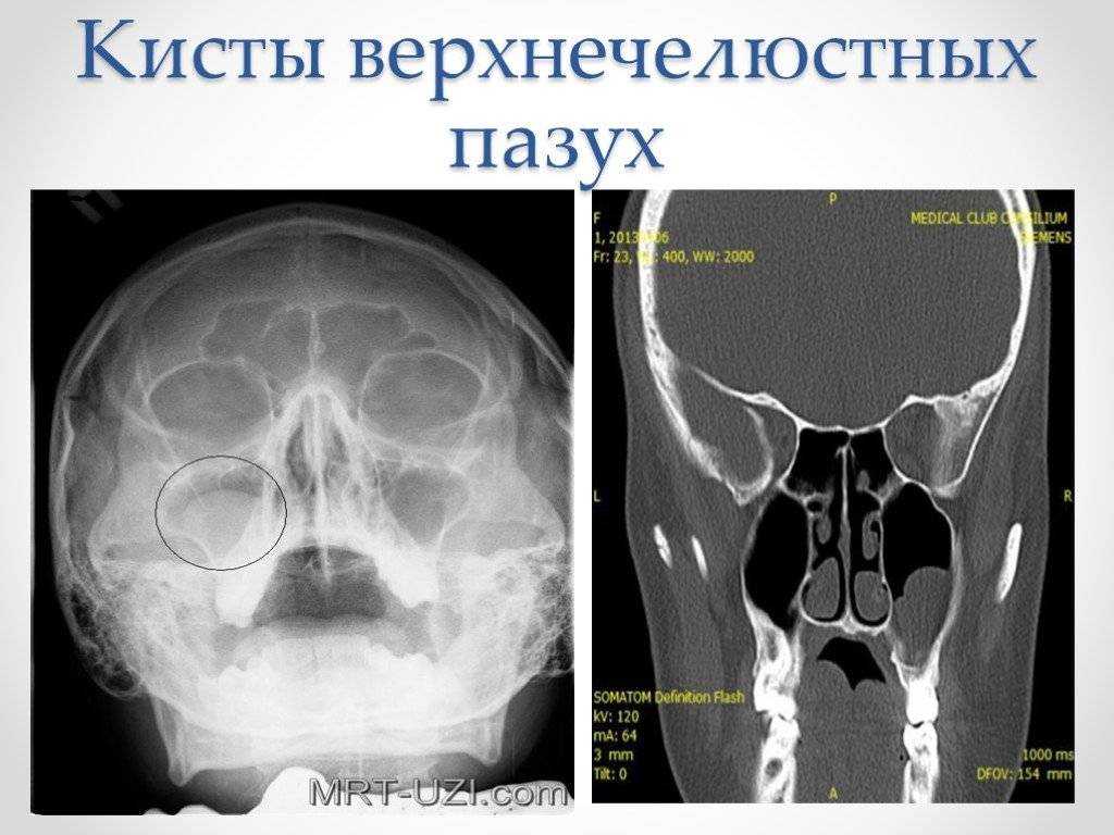 Киста гайморовой пазухи - признаки, причины, симптомы, лечение и профилактика - idoctor.kz