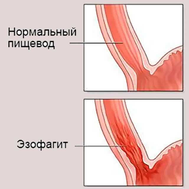 Диета при изжоге: причины назначения, меню и особенности питания