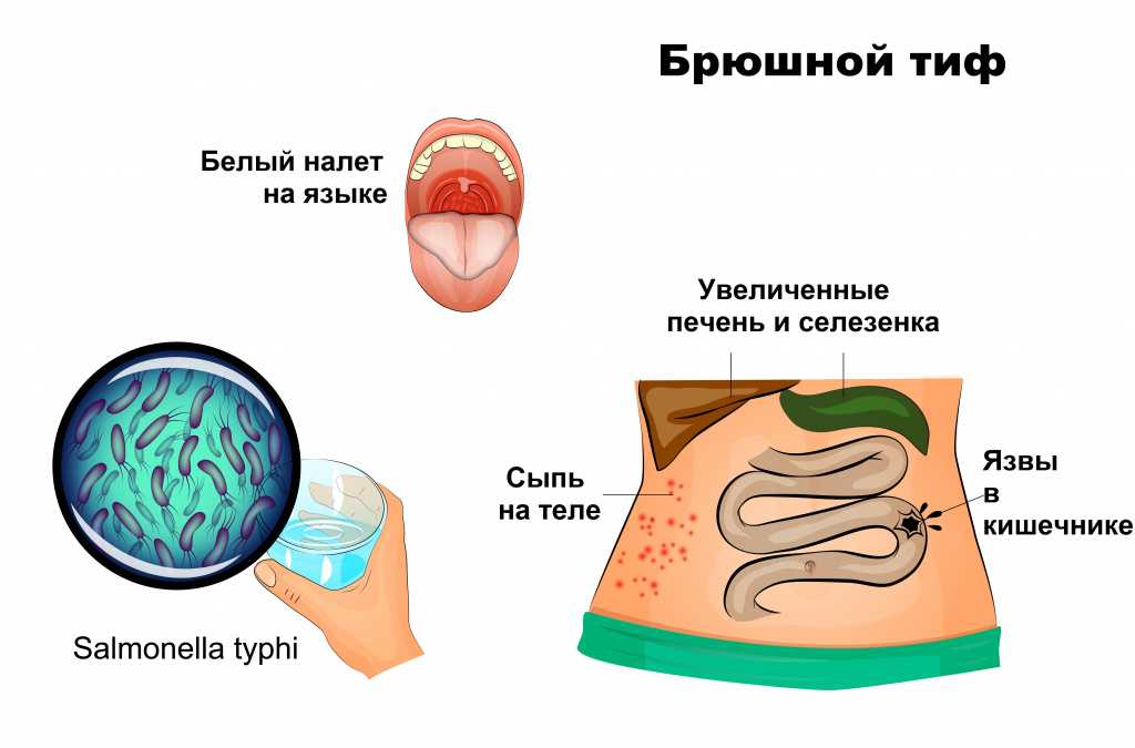 Как вовремя распознать брюшной тиф: симптомы и методы диагностики  Брюшной  Тиф  Брюшной тиф у взрослых и детей  Брюшной тиф представляет собой острую