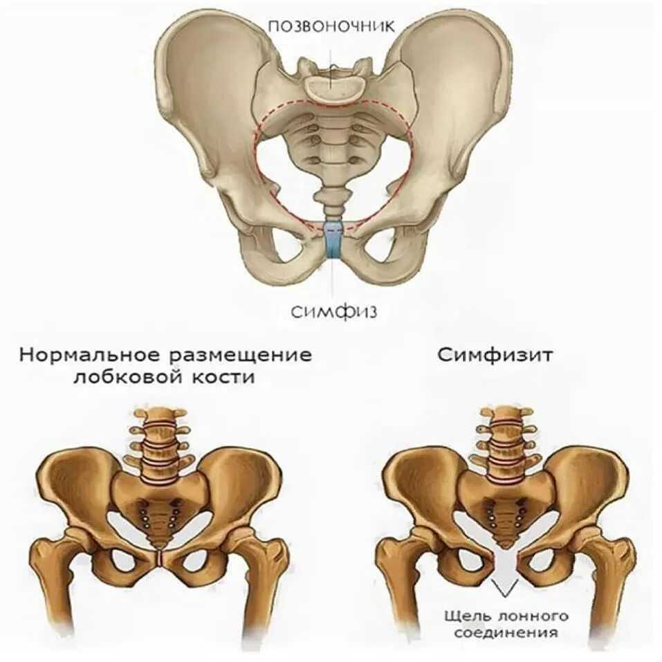 Почему при беременности болит лобковая кость и что с этим делать?