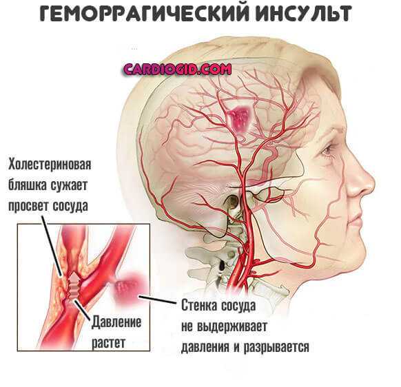 Как лечить сосуды головного мозга при гипертонии: эффективные методы и рекомендации
