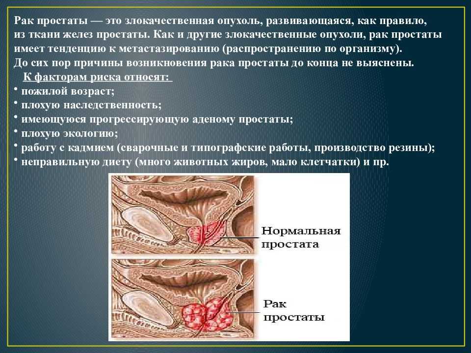 Лечение после лучевой терапии рака простаты