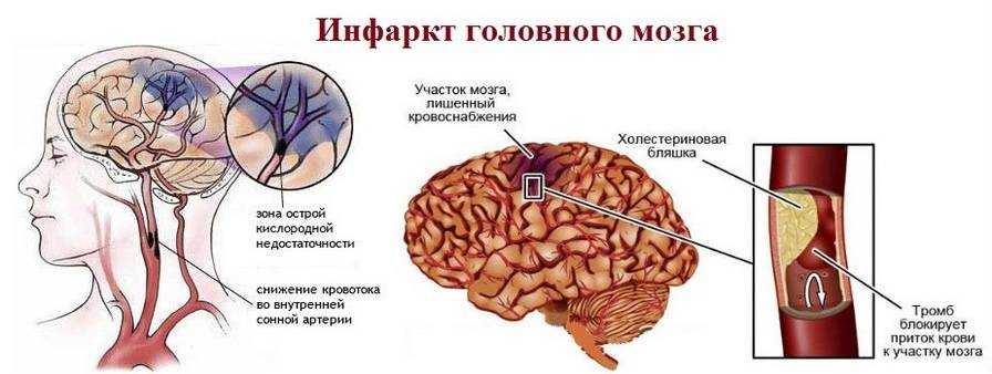 Ишемический инсульт головного мозга - симптомы, последствия