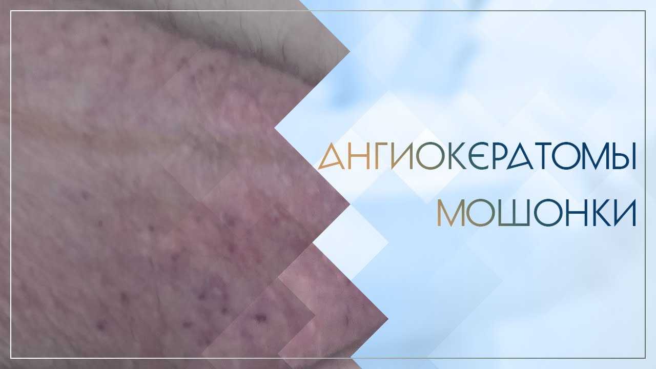 Ангиокератома - симптомы, причины, диагностика и лечение