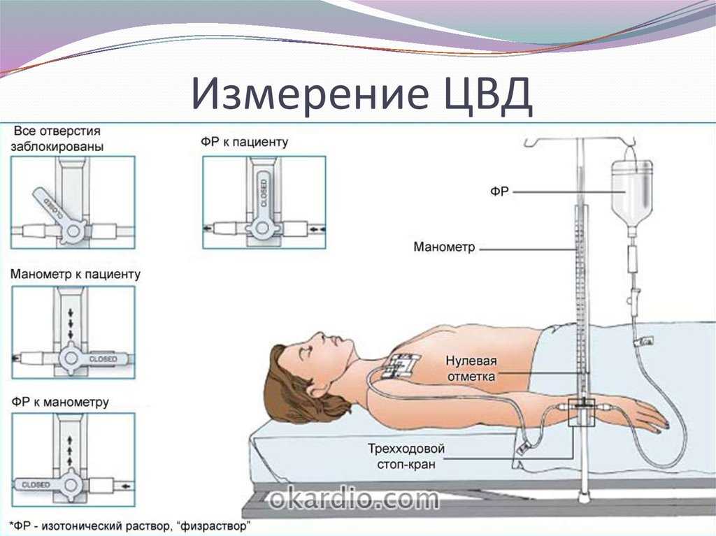 Центральное венозное давление (цвд) в медицине: что это, алгоритм измерения, норма у взрослых