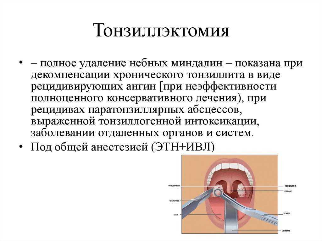 Прижигание миндалин - эффективный метод лечения тонзиллита