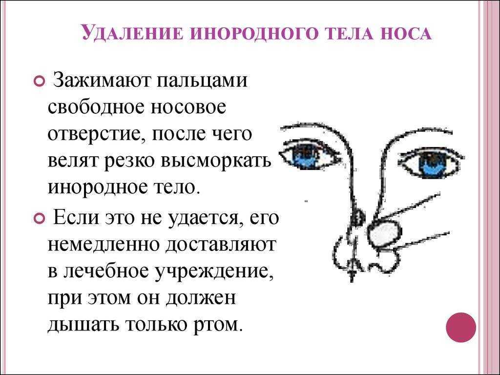 Первая помощь при попадании инородного тела в нос: правила оказания | food and health