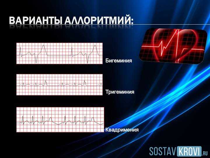 Бигеминия: причины, симптомы, лечение