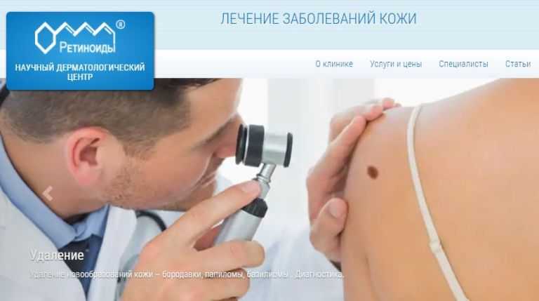 Удаление родинки хирургическим путем (операция иссечение)