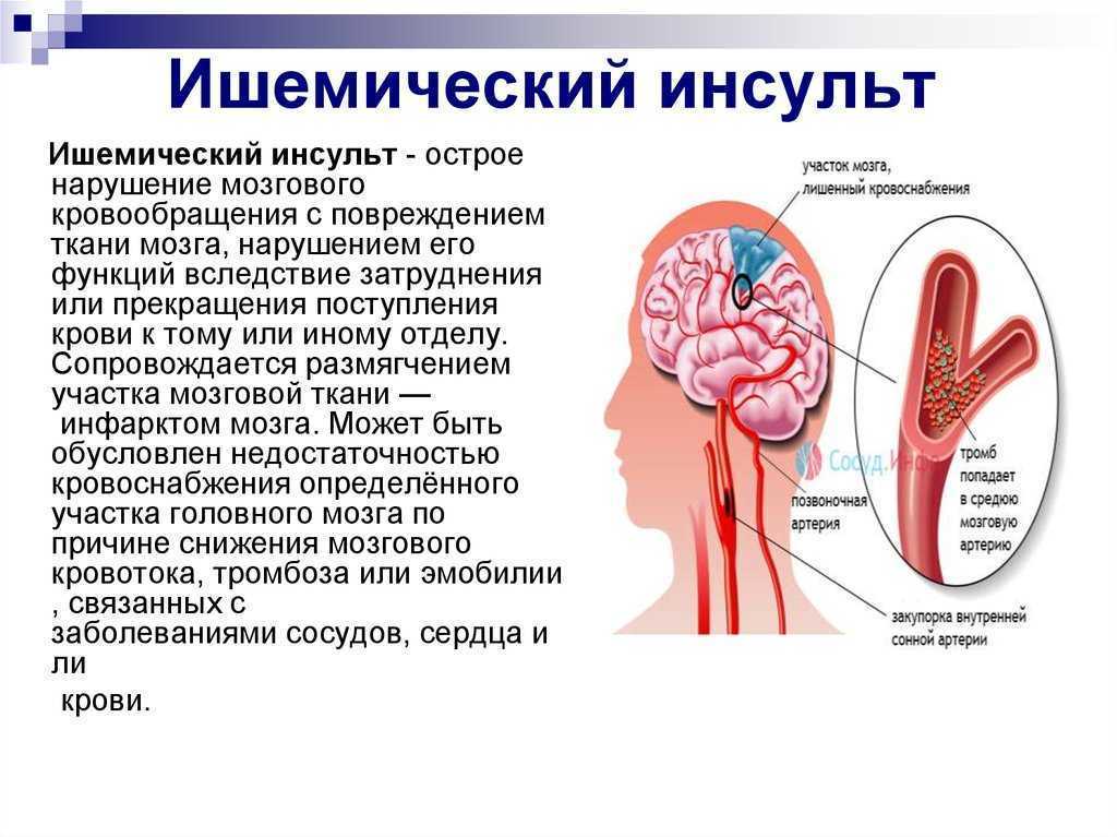 Современные подходы диагностики и лечения острого инсульта