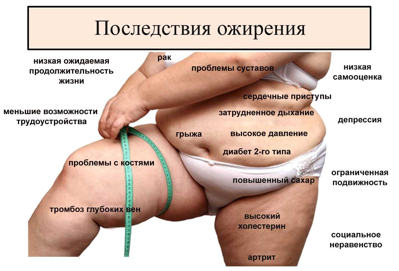 Ожирение: причины, симптомы, диагностика и лечение