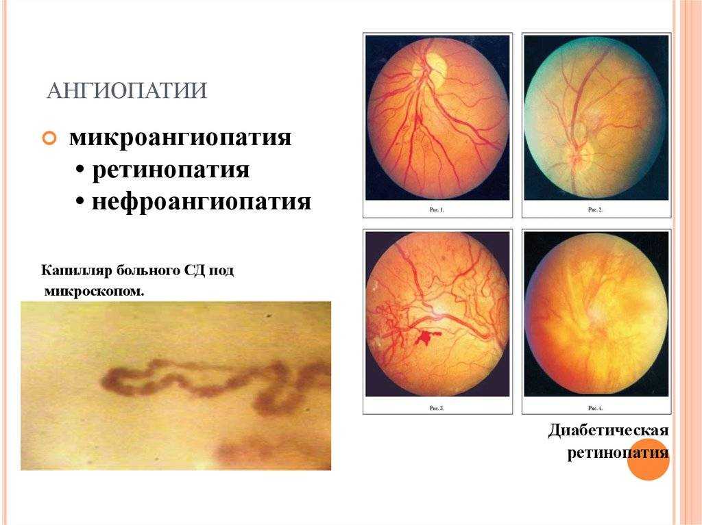 Ru2649498c1 - способ лечения ишемической ангиопатии сосудов нижних конечностей 
        - google patents