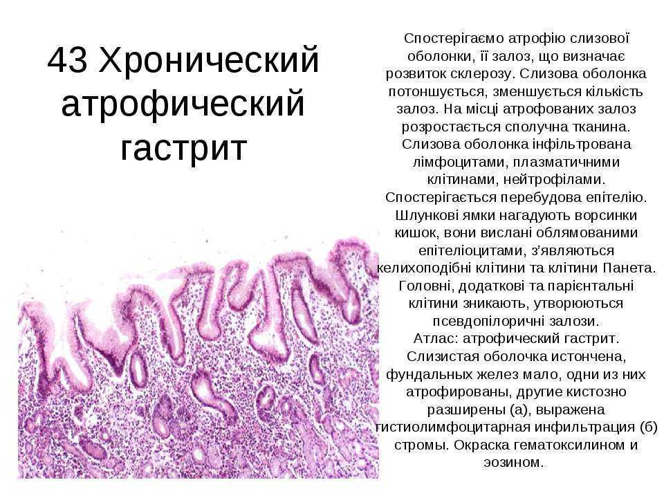 Фовеолярная гиперплазия желудка – почему важна своевременная диагностика патологии?
