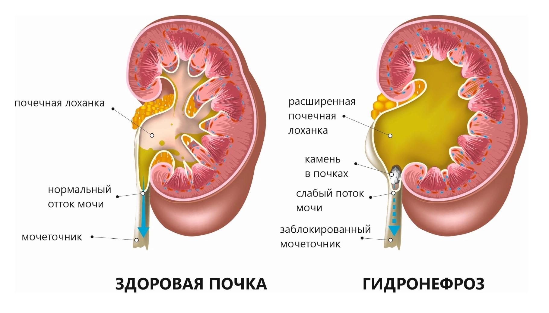 Каликоэктазия почек, что это за заболевание, причины, симптоматика и варианты лечения