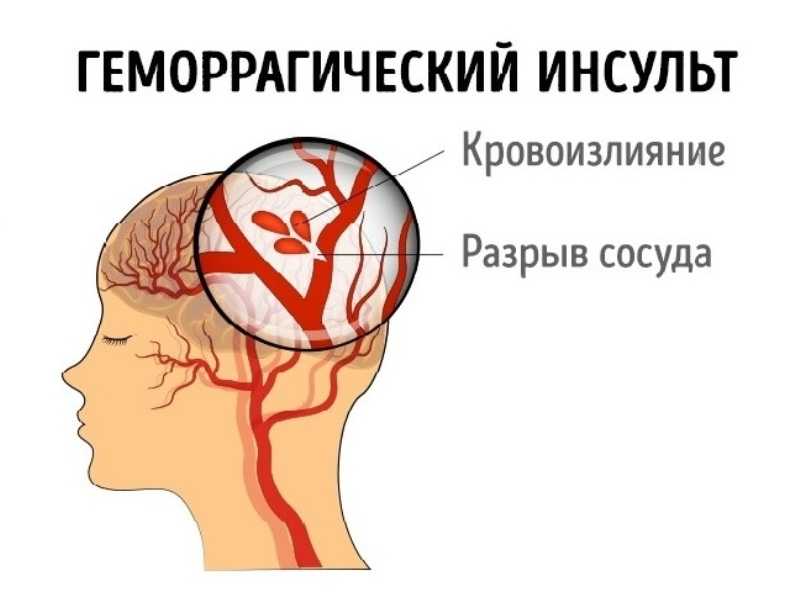 Геморрагический инсульт: причины, симптомы, лечение, прогноз, профилактика