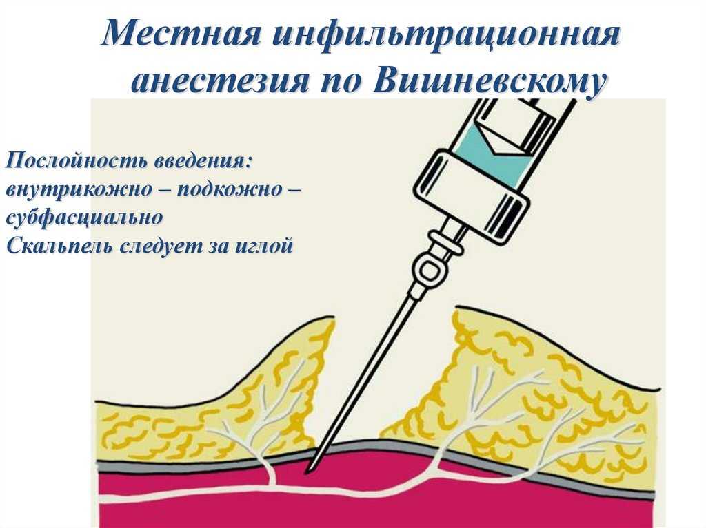 Инфильтрационная анестезия: основные принципы и применение
